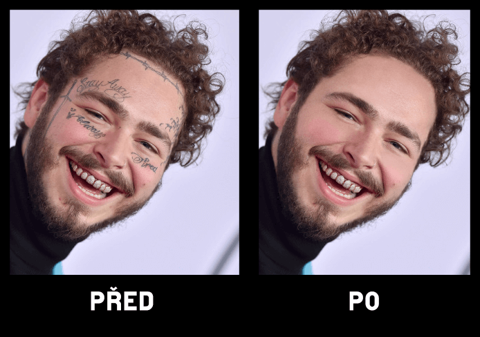 Vyhlazení nedokonalostí obličeje / těla včetně tetování
