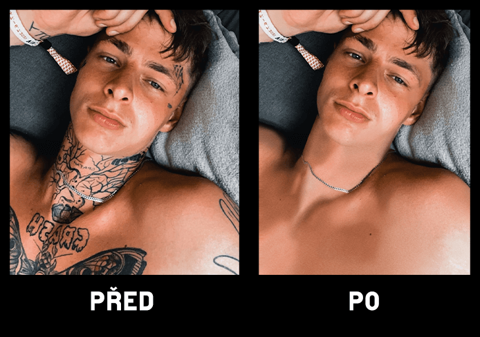Vyhlazení nedokonalostí obličeje / těla včetně tetování